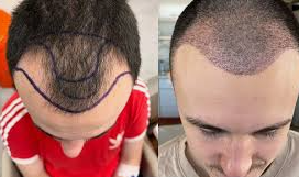 Understanding Hair Transplantation